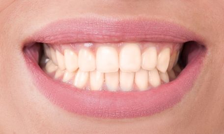 Vorher/Nachher-Ergebnis Bleaching