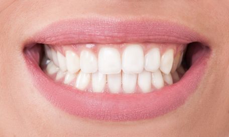 Vorher/Nachher-Ergebnis Bleaching Vorher/Nachher-Ergebnis Bleaching